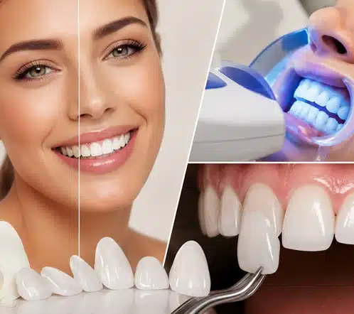 bleaching veneers regensburg